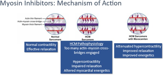cardiomyopathies hypertrophiques
