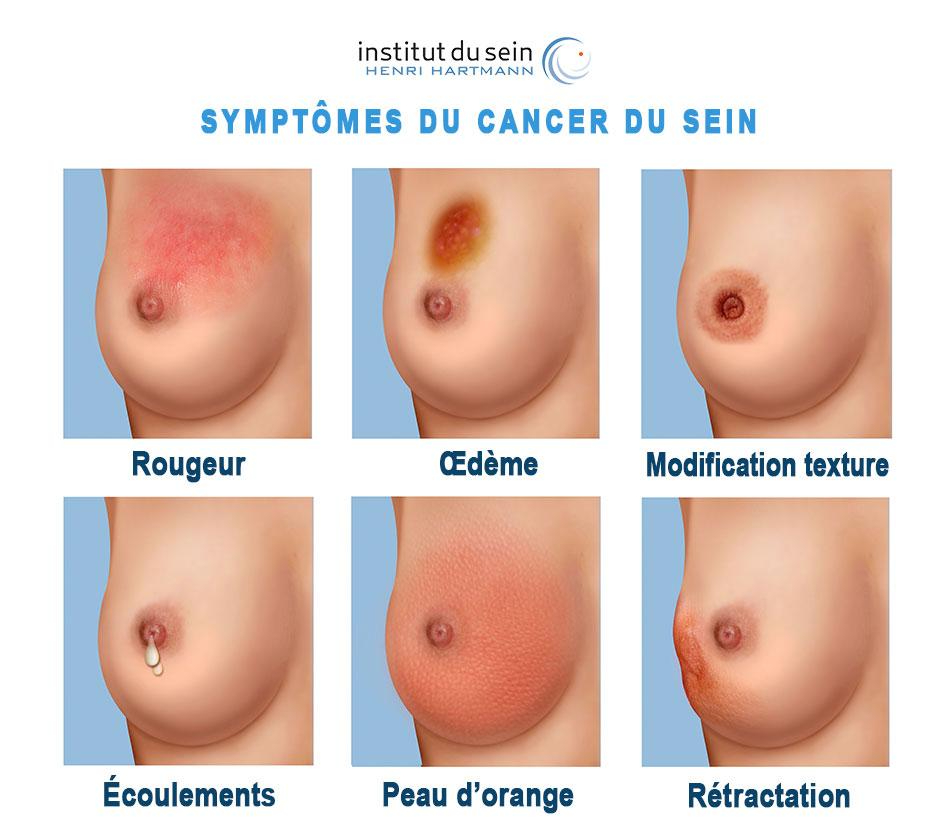 symptomes cancer du sein