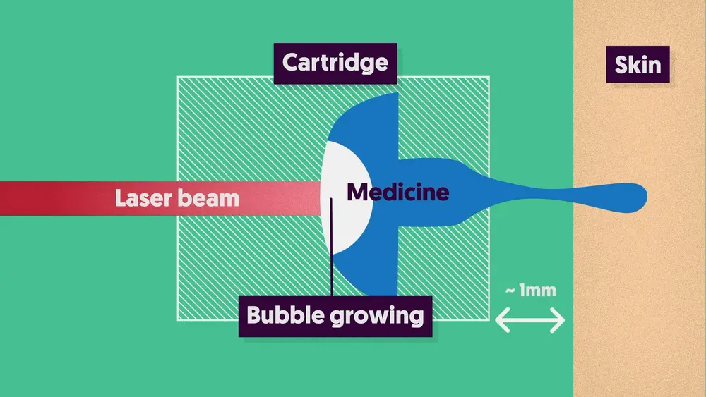 met behulp van laser-opgewekte cavitatie.
