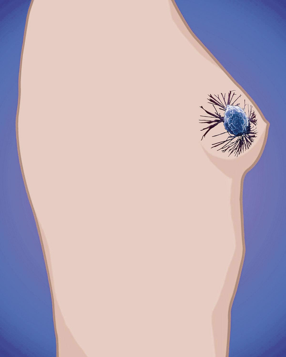 Cancer du sein triple négatif: l'immunothérapie peut-elle jouer un rôle?