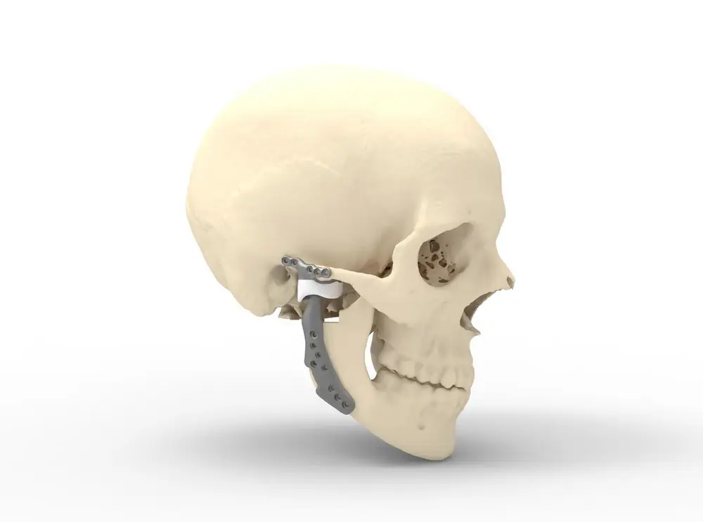 La prothèse articulaire temporo-mandibulaire est modélisée en titane 3D en fonction de la pathologie.