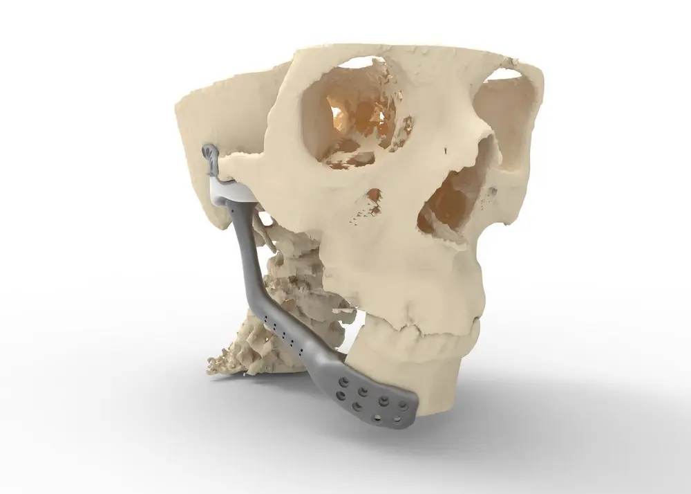 La prothèse en version étendue pour remplacer une partie de la mandibule.