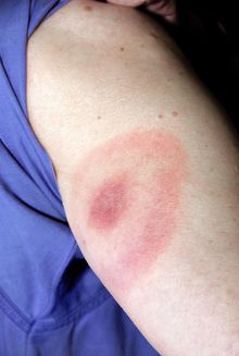 Lyme disease rash. Close-up of the upper arm of a female patient, showing an erythematous rash around the site of a tick bite. This rash is characteristic