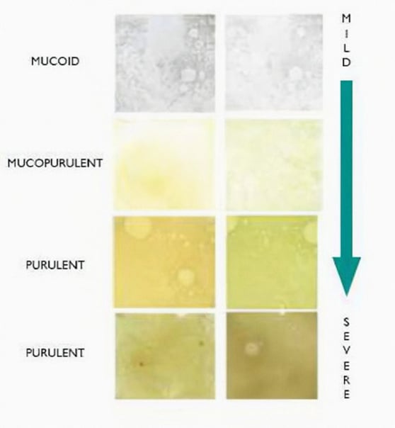 Kleur van de fluimen voorspelt prognose van patiënten met bronchiëctasieën