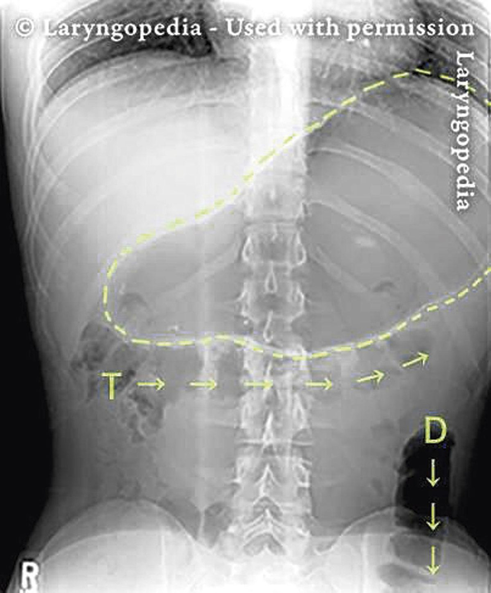 Cette radiographie abdominale d'un individu atteint de R-CPD montre une bulle d'air gastrique remarquablement volumineuse (ligne en pointillés), ainsi qu'un excès d'air dans le côlon transverse (T) et descendant (D). Tout cet air en excès peut entraîner une distension abdominale qui s'aggrave au fil de la journée. (c) Laryngopedia