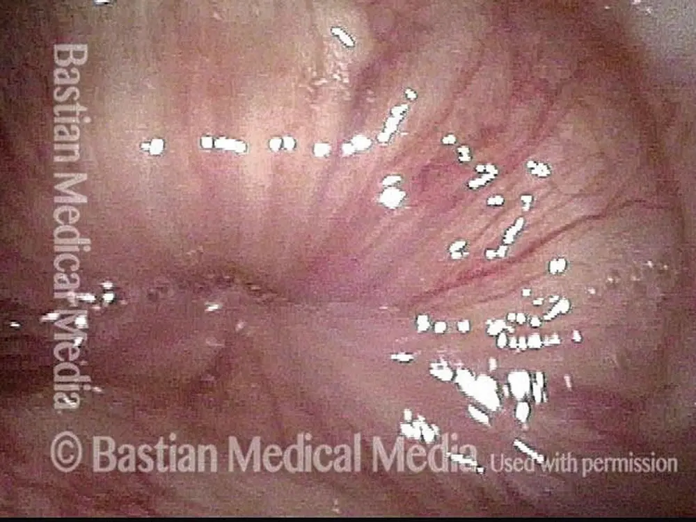 Vue en gros plan du muscle cricopharyngien. Lorsqu'il est contracté comme ici, il ferme hermétiquement l'entrée de l'oesophage. Lorsqu'une personne avale, le muscle se relâche et l'entrée de l'oesophage s'ouvre largement pour laisser passer les aliments ou les liquides.