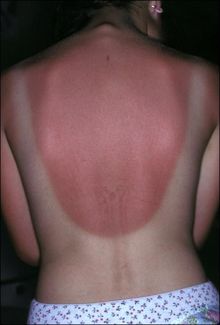 Aspirine tegen zonnesteek