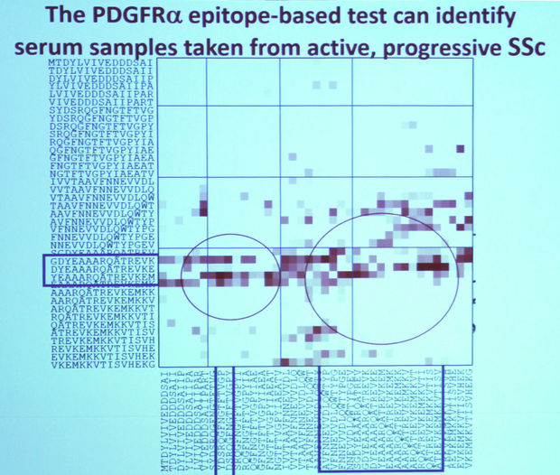Sclerodermie: een nieuwe, veelbelovende test ...