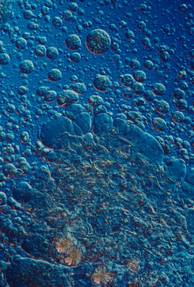 Rôle pronostique de la graisse dans les cancers de l'oesophage