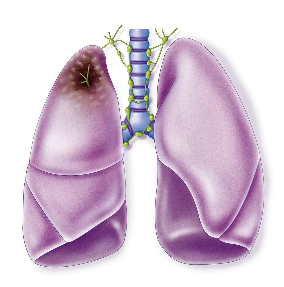 Progrès tous azimuts dans les NSCLC