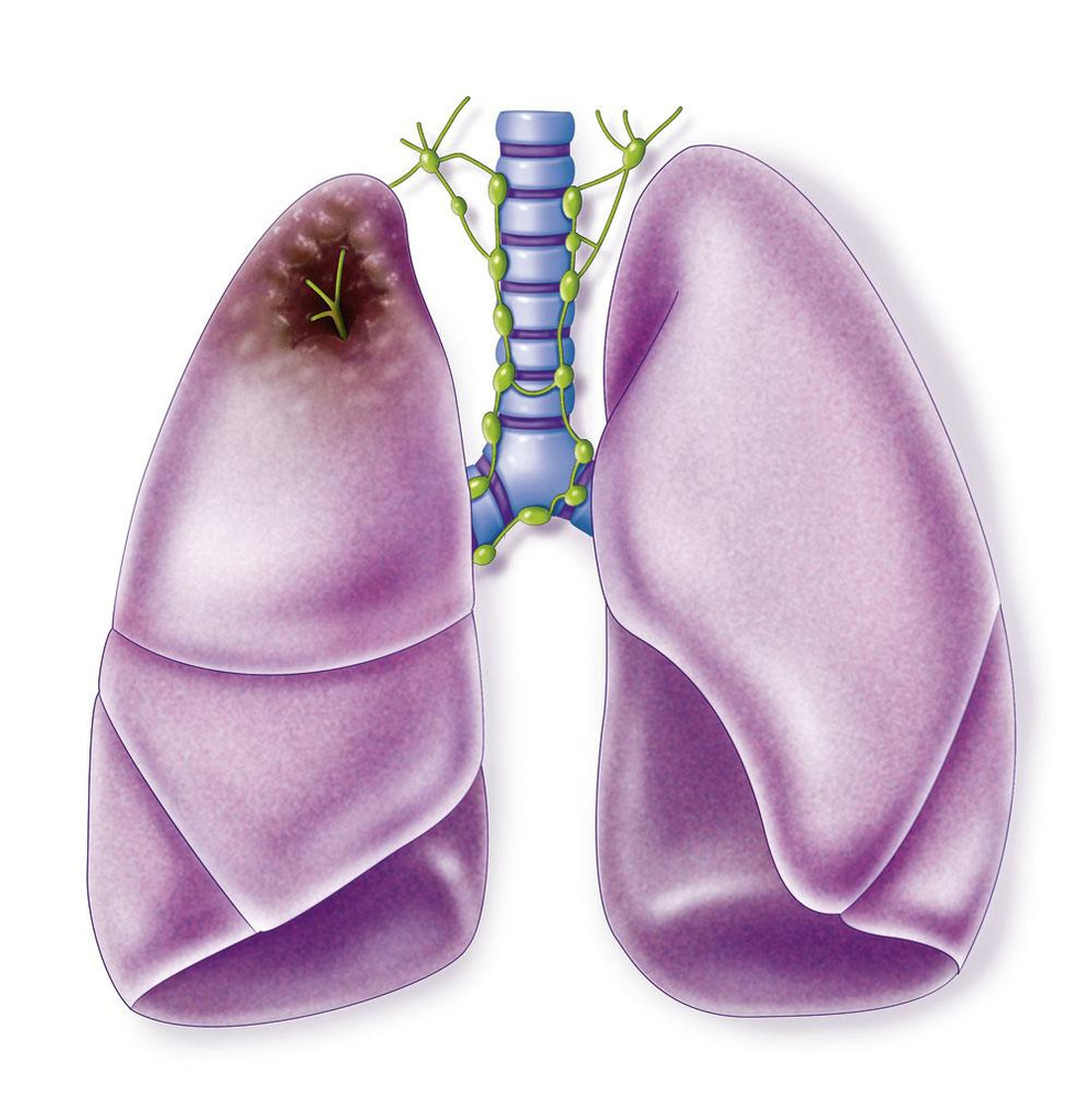 Vooruitgang uit alle hoeken voor NSCLC