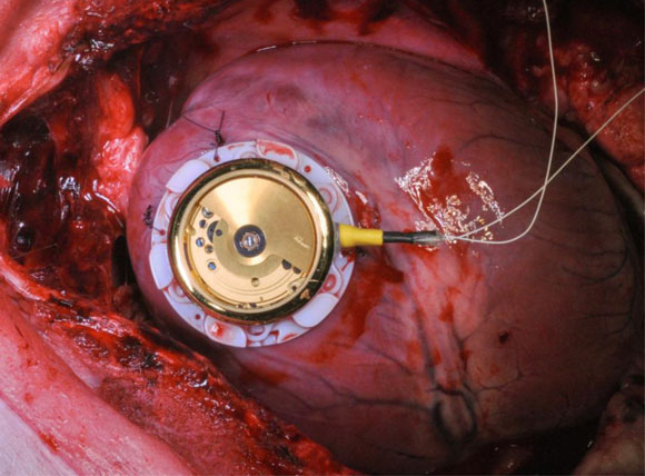 Een Zwitsers horloge voor een pacemaker zonder batterij