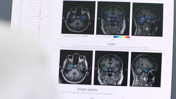 Epilepsie sneller vaststellen