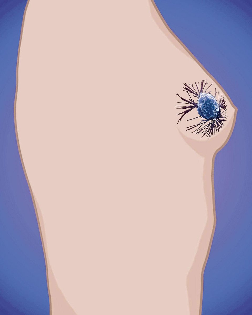 Triple negatieve borstkanker: is er een rol voor immunotherapie?
