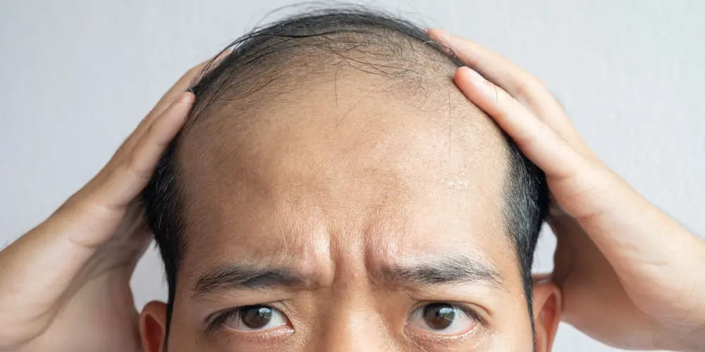 Homme dégarni se tenant les cheveux