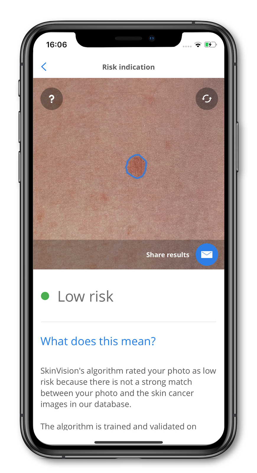 SkinVision app screenshot