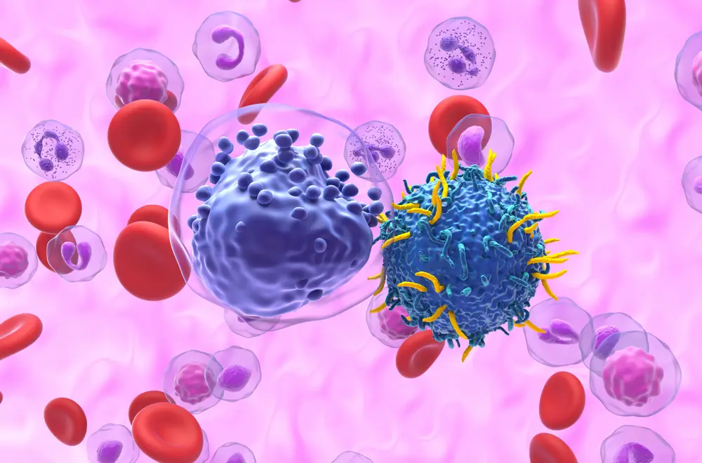 Illustration d'un lymphocyte T à récepteur antigénique chimérique (CAR) (bleu) attaquant des précurseurs de globules blancs cancéreux (violet) dans un cas de leucémie aiguë myéloïde (LAM). Des globules rouges sains (disques) et des globules blancs (roses) sont visibles en arrière-plan.  © Getty Images