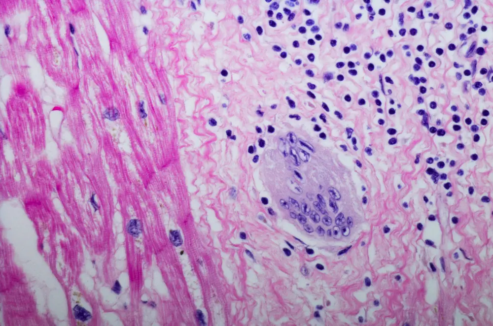 Sarcoïdose scan