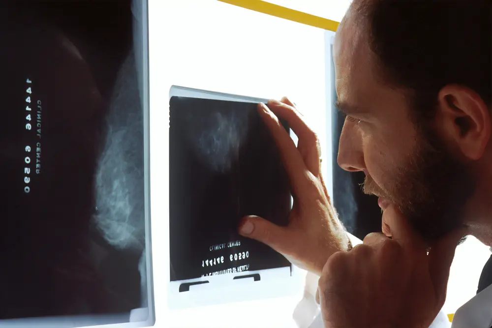 Dépistage cancer du sein 