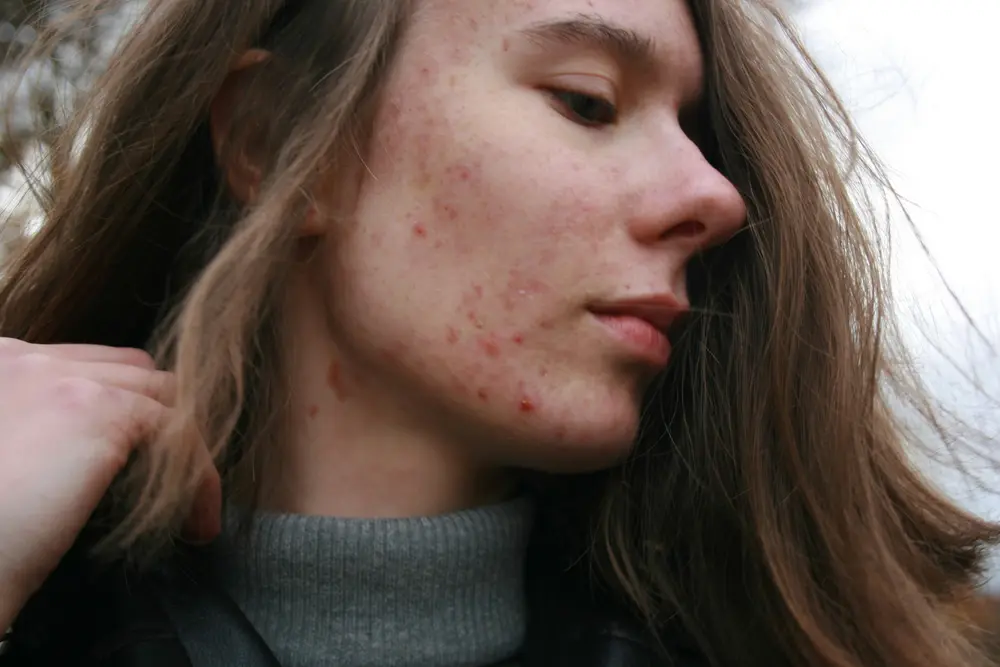 acne opstoot herfst