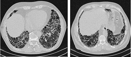 image chez un patient atteint de fibrose pulmonaire.