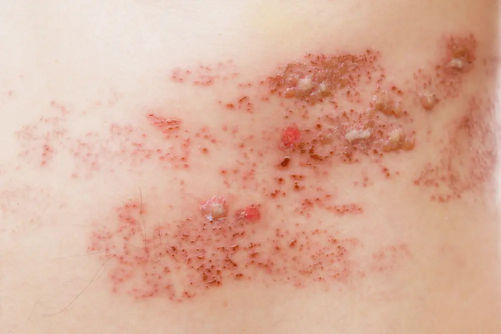 herpes zoster zona