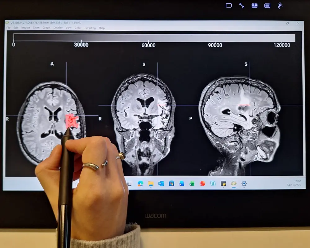 MRI hersenen met annotatie