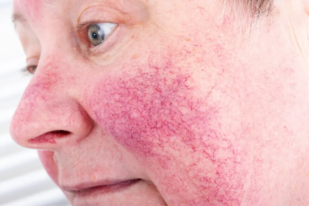 rosacea