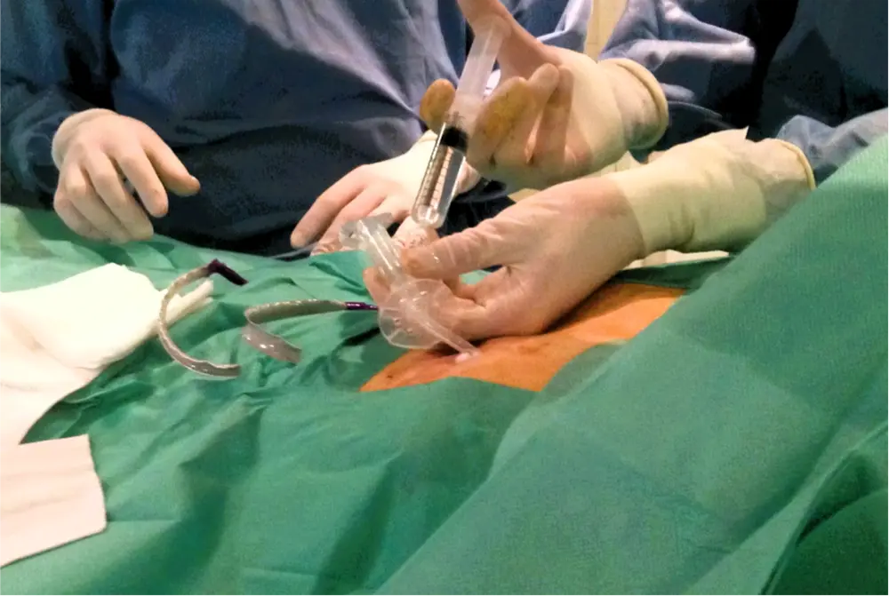 gastrostomie par voie percutanée