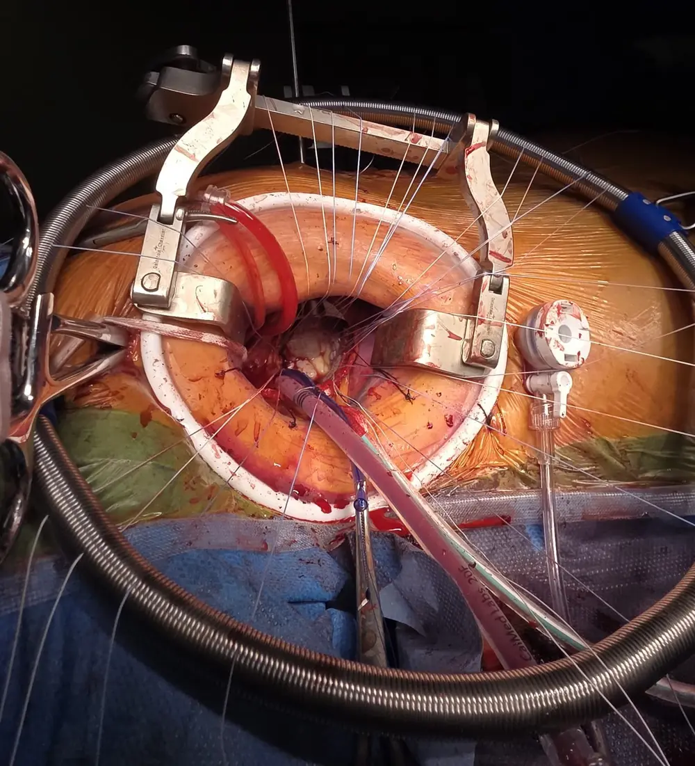 chirurgie valve voie axillaire