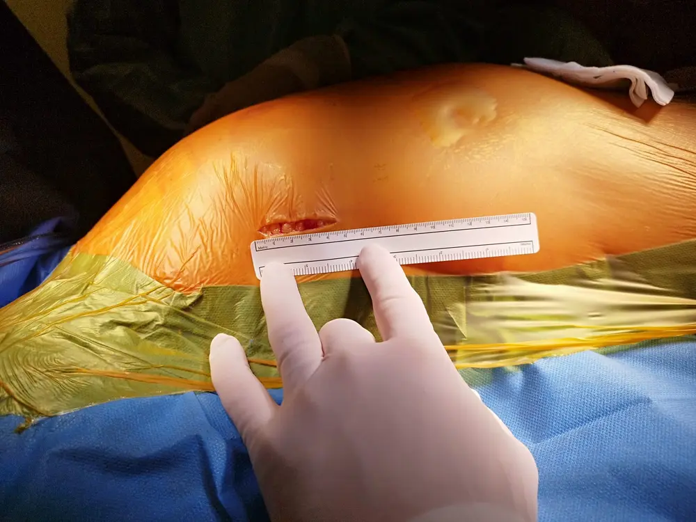 Hôpital Citadele abord transaxillaire