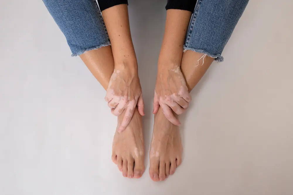 Vitiligo: duurzame werking van ruxolitinib-crème 