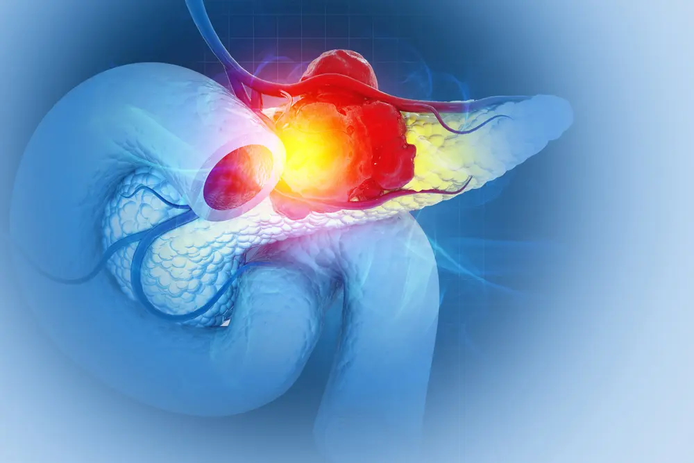 Pancreaskanker: van diagnose naar behandeling