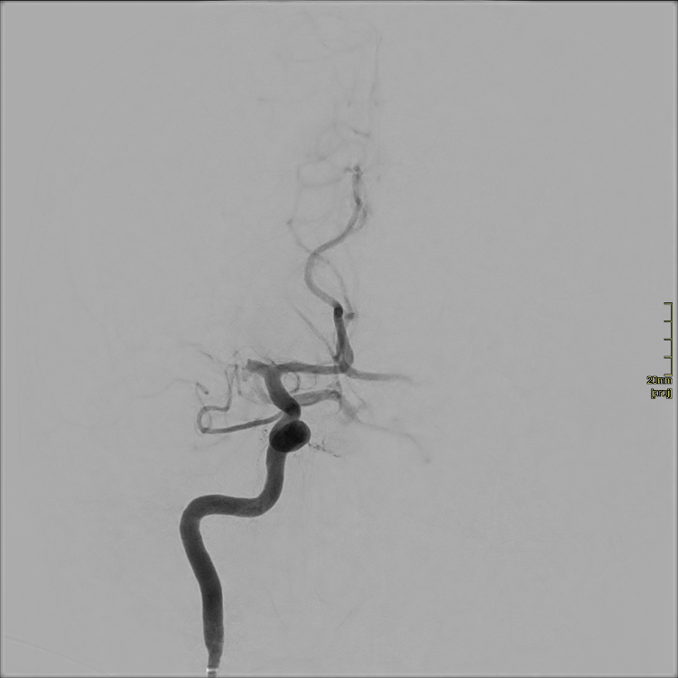 AVC artère thrombus