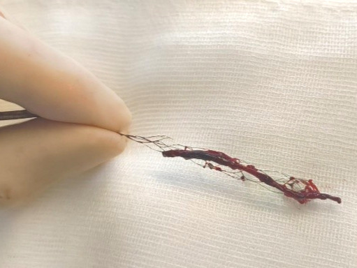 AVC thrombus thrombectomie