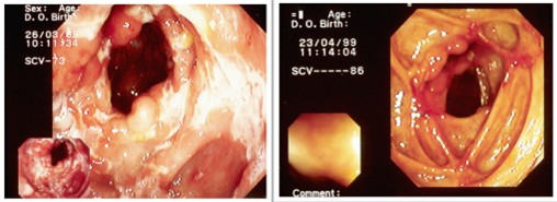 Pas gediagnosticeerde ziekte van Crohn: fenotype van patiënten en behandeling