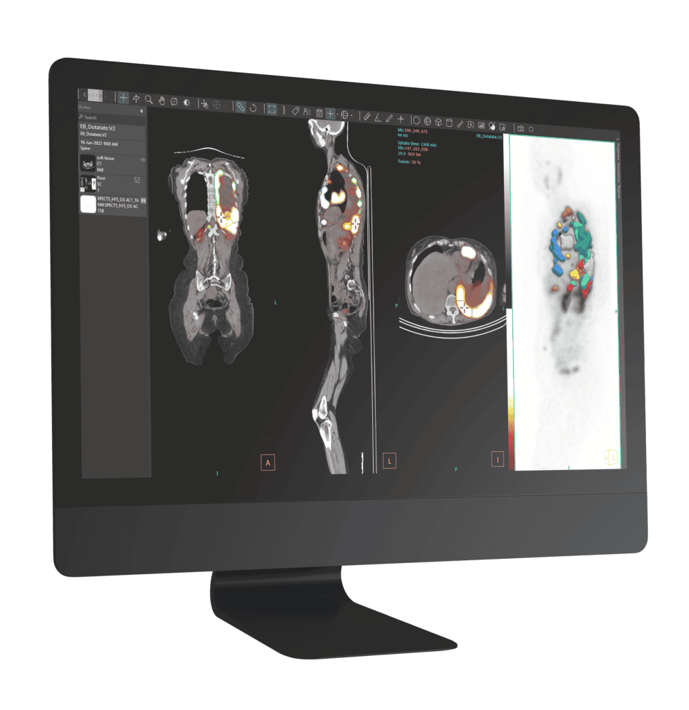 gamma-caméra SPECT/CT écran